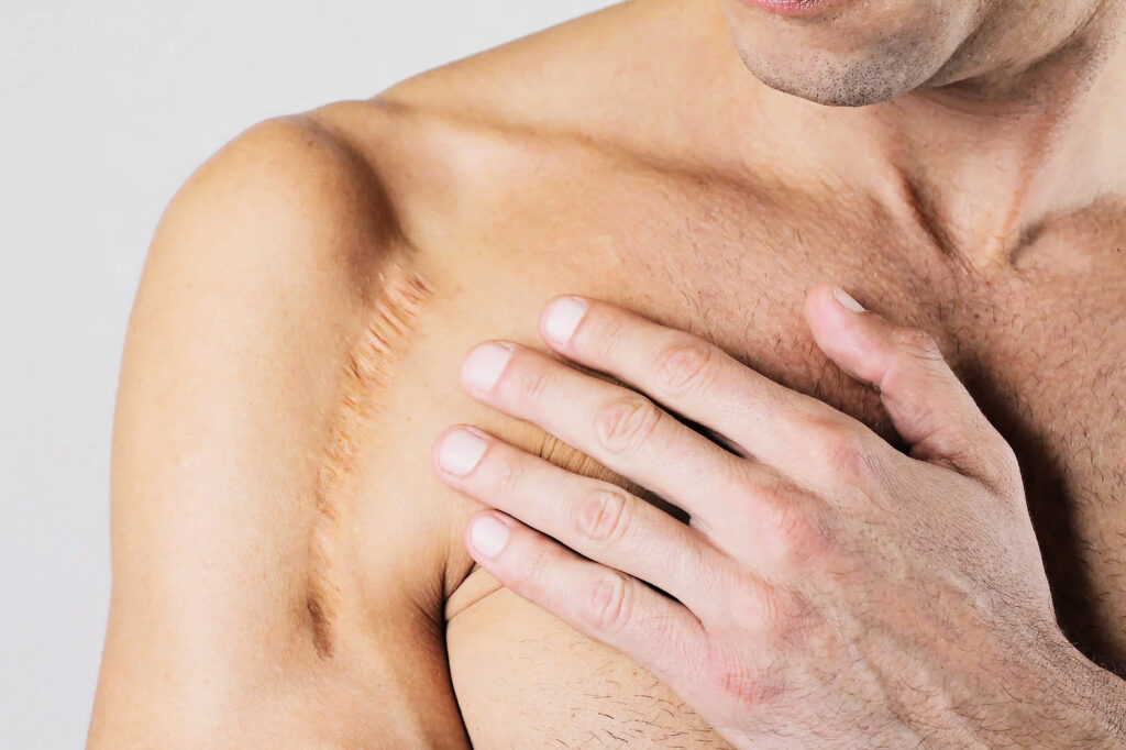 Mann berührt mit der Hand die Schulter mit sichtbarer Narbenlinie am Oberarm-Schulterbereich.
